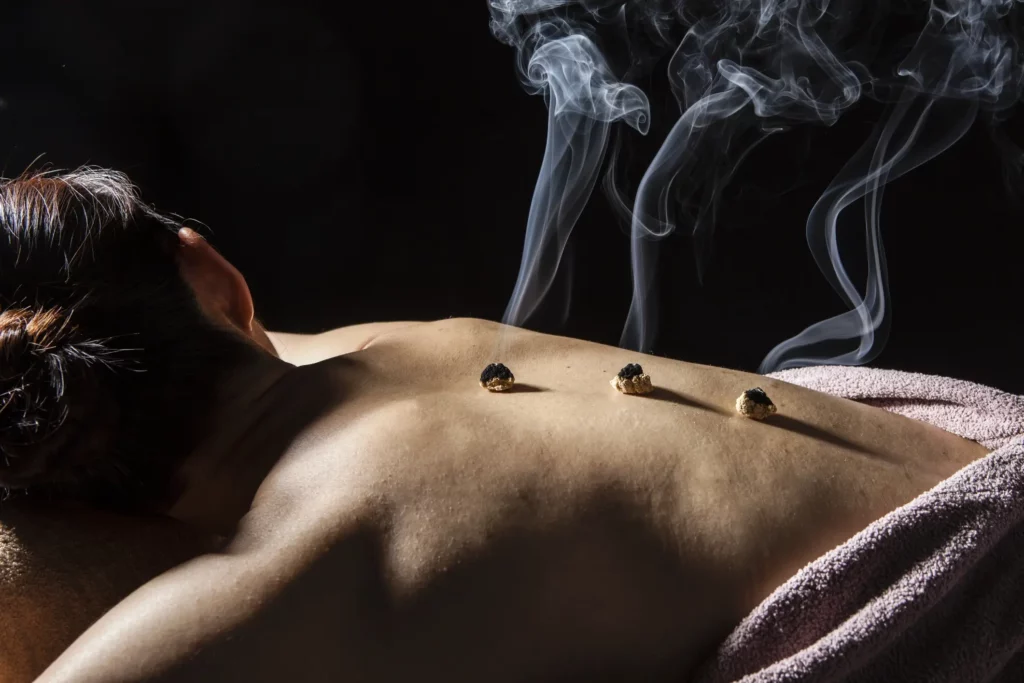Application de moxibustion et acupuncture pour rééquilibrer l'énergie vitale (Qi), à Montady