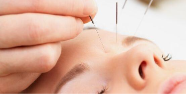 Séance d'aculifting à Montady pour le rajeunissement du visage.